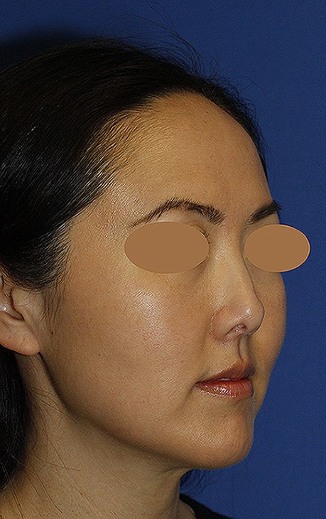 Rhinoplasty Before R Oblique