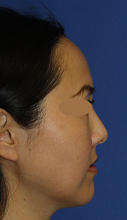 Rhinoplasty Before R Profile