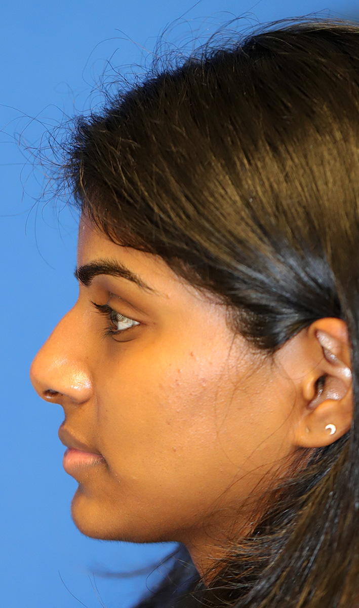 L profile before