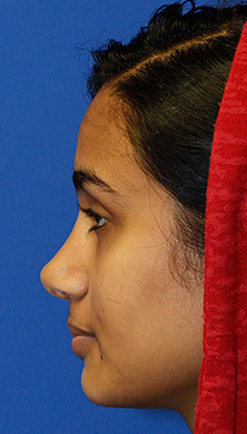 Indian rhinoplasty postop profile