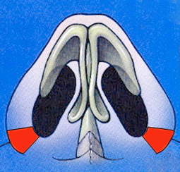 Alar base excision removing vestibular skin
