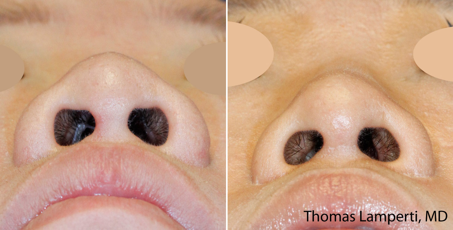 Asian rhinoplasty nostril reduction