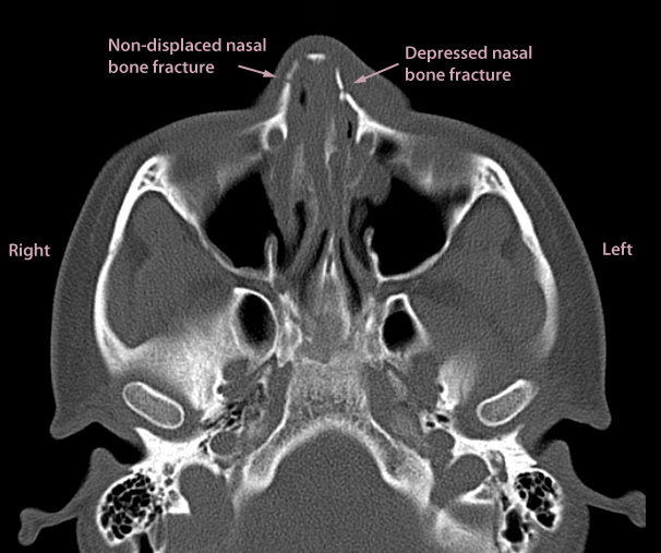 Axial facial CT scan showing nasal bone fractures 