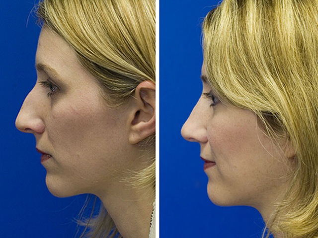 before-and-after-photos-bridge-bump-removal-profile.jpg