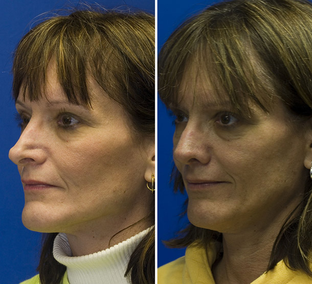 External valve collapse and alar retraction before and after revision rhinoplasty