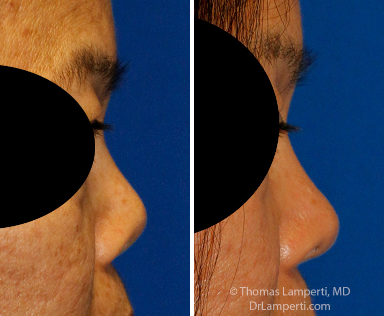 Revision rhinoplasty patient 20 right profile before and after upturned tip repair