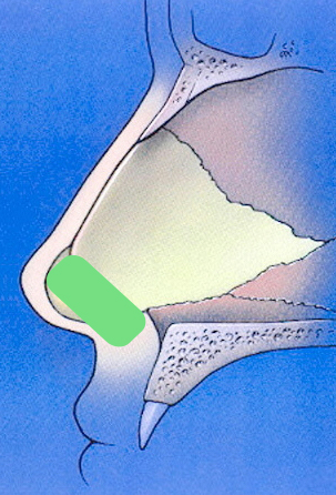 Caudal septal extension graft schematic profile view