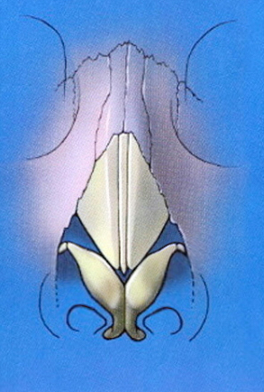 Schematic showing LLC cephalic positioning