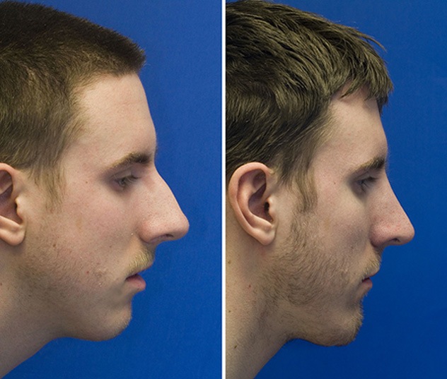 Patient 9 before and after chin implant and rhinoplasty with hump reduction