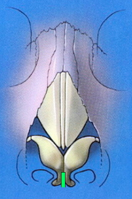 columellar-strut-schematic-frontal.jpg