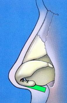 columellar-strut-schematic-profile.jpg