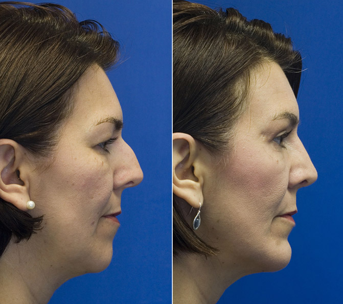 combined-chin-implant-sliding-genioplasty-and-blepharoplasty-patient-2-profile.jpg