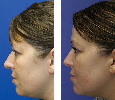 Patient 6 combined rhinoplasty and blepharoplasty before and after profile