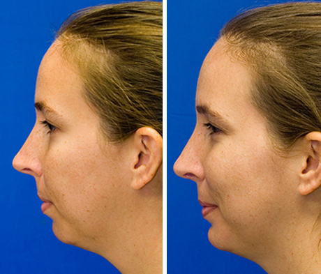 combined rhinoplasty and sliding genioplasty