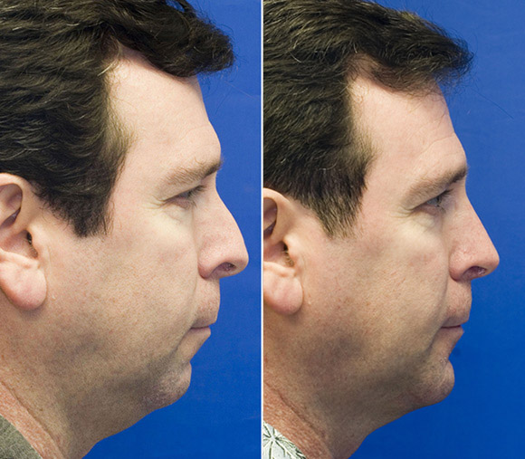 combined-sliding-genioplasty-and-rhinoplasty-patient-1-profile-photo.jpg