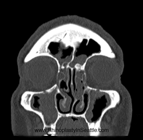 Coronal sinus CT scan with diffuse polyps and chronic sinusitis