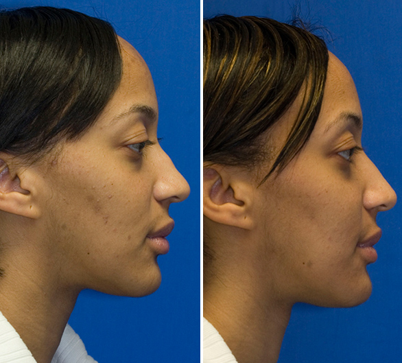 African American rhinoplsaty hump reduction