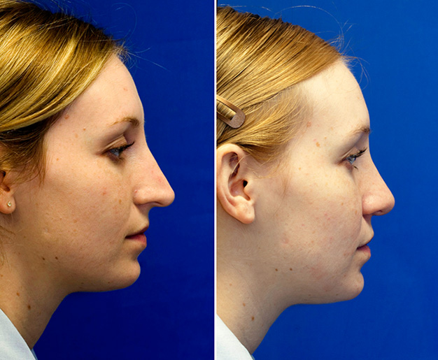 Drooping long nose rhinoplasaty repair