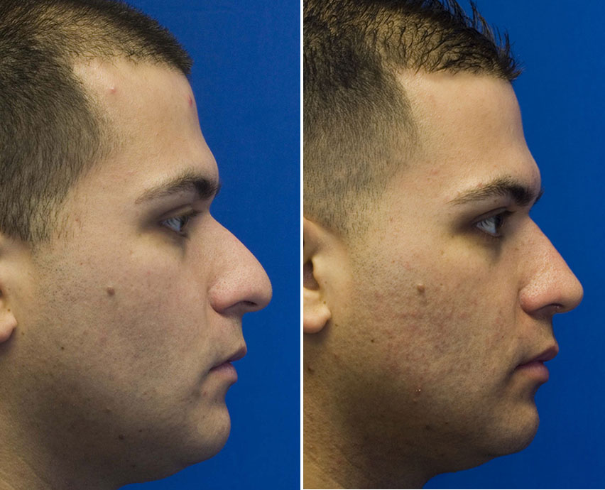 Patient 11 profile hump reduction and tip ptosis repair 