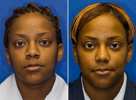 African American nostril reduction with alar base excision