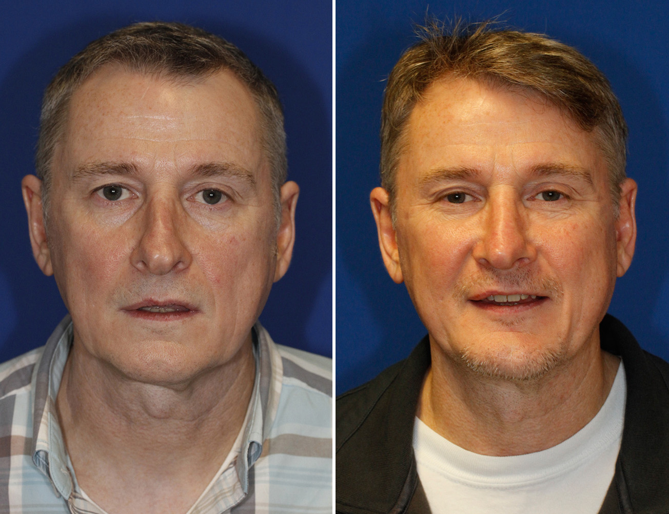 Before and After frontal view of male revision rhinoplasty patient