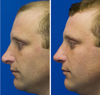 Revision rhinoplsaty to repair hanging columella, alar retraction and pollybeak deformity