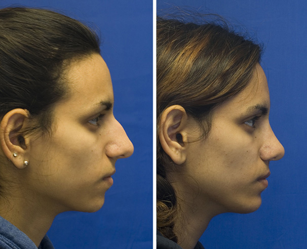 Indian rhinoplasty profile before and after with hump removal. Notice the mild amount of tip deprojection. A medium sized silastic chin implant was also placed.