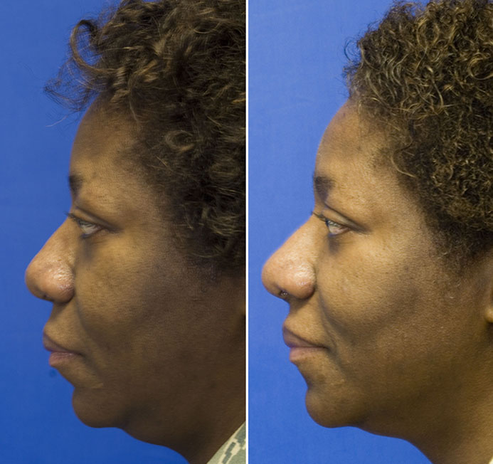 African American rhinoplasty increase tip projection