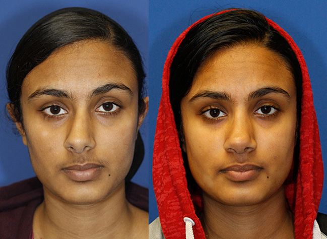 Indian rhinoplasty patient 28 before and after frontal. Click photo to see more.