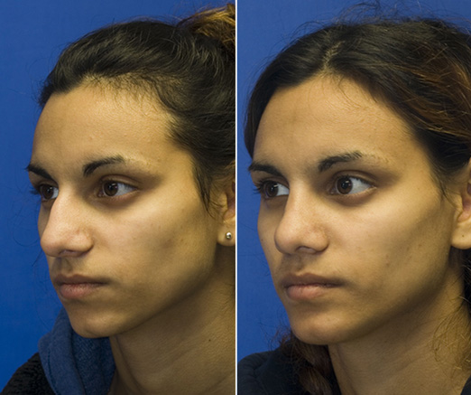 Indian rhinoplasty patient 23 oblique before and after photos. This patient also had a chin implant placed. Click to see more.