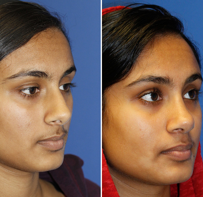 Indian rhinoplasty patient 28 right oblique montage. Click for more photos.