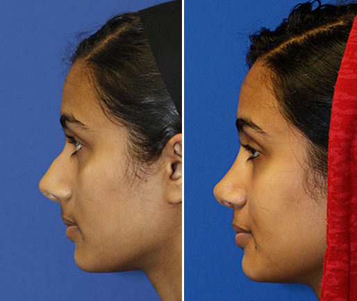 Rhinoplasty Anatomy by Seattle Rhinoplasty Surgeon DrPhilip Young - Blog  Aesthetic Facial Body Plastic Surgery