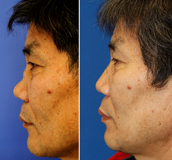 Saddle Nose Deformity Rhinoplasty In Seattle Rhinoplasty Surgeon