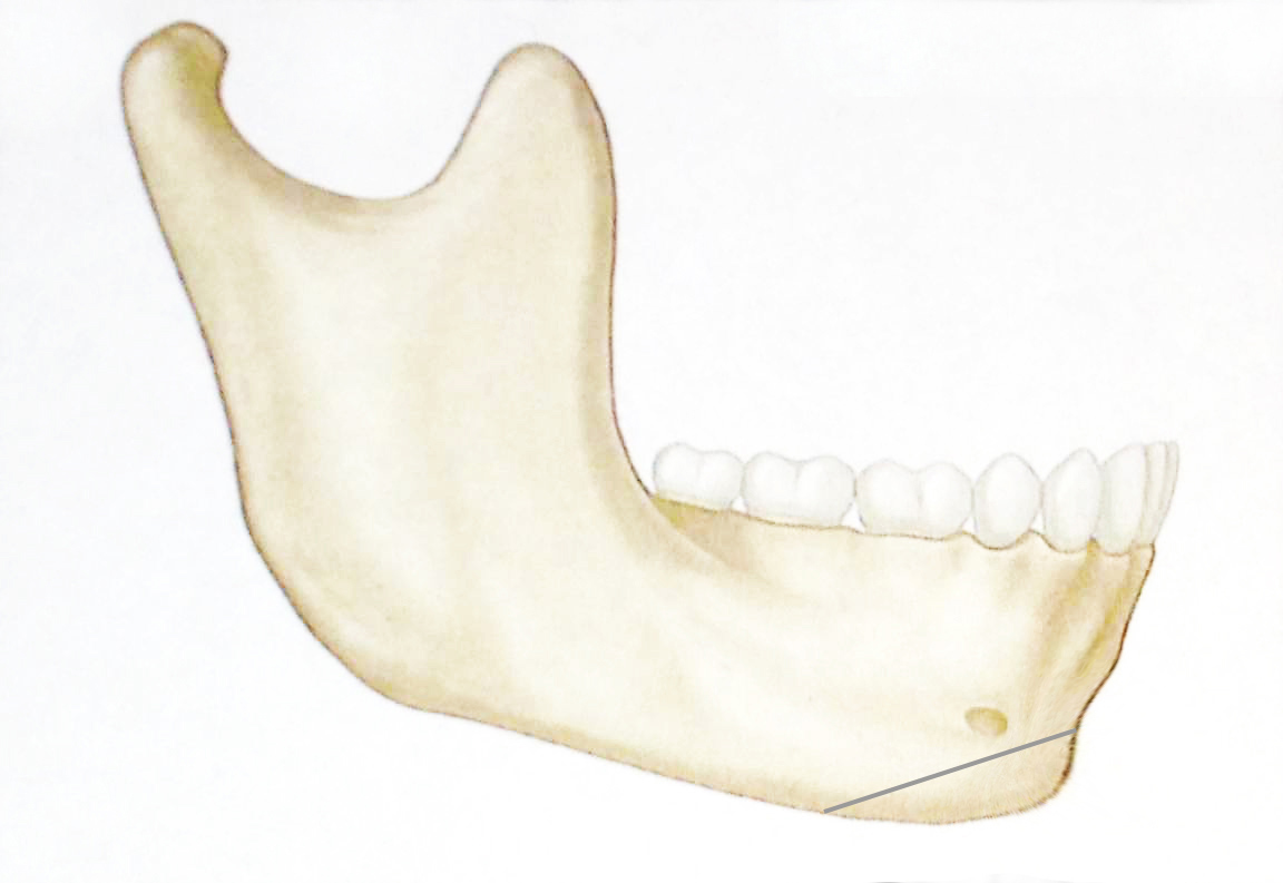 lateral mandible retrusive chin with osteotomy.jpg