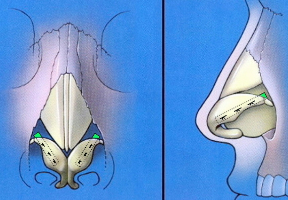 Lower lateral crura strut grafting schematic with frontal and profile views.