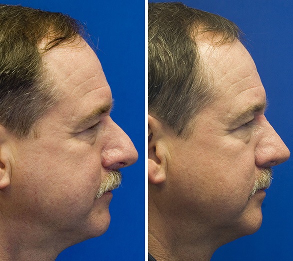 male thick skin hump removal before and after