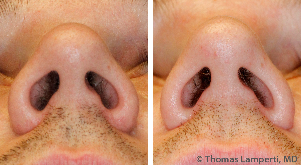 Caucasian male alar base reduction before and after photos.jpg