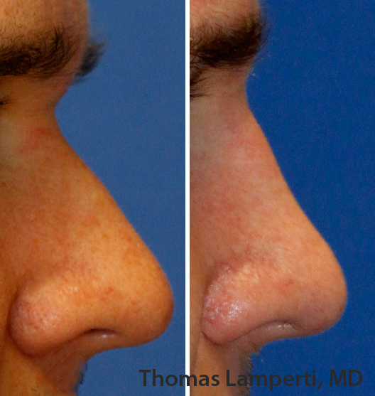 Before and after radix graft caucasian male rhinoplasty.jpg