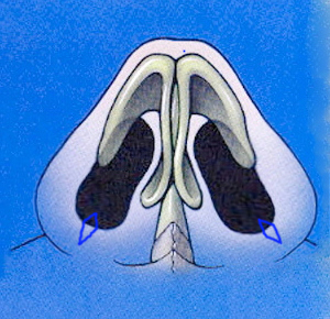 Nasal sill diamond shaped nasal base narowing