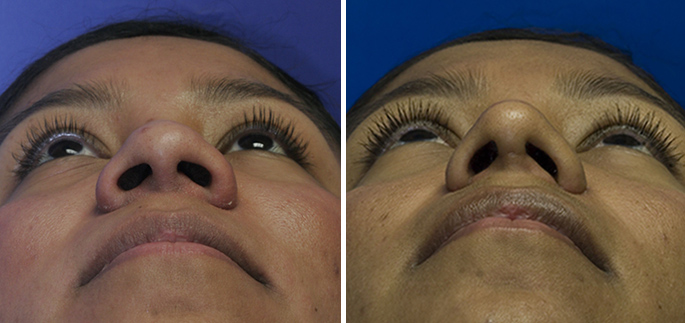 Hispanic nostril narrowing with alar base reduction