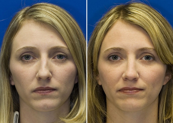 Patient 1 with left middle third narrowing and appearance of nasal deviation