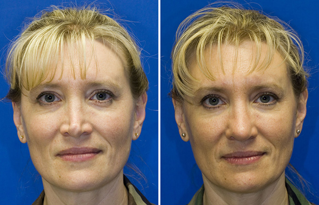 Pinched Tip | Rhinoplasty in Seattle