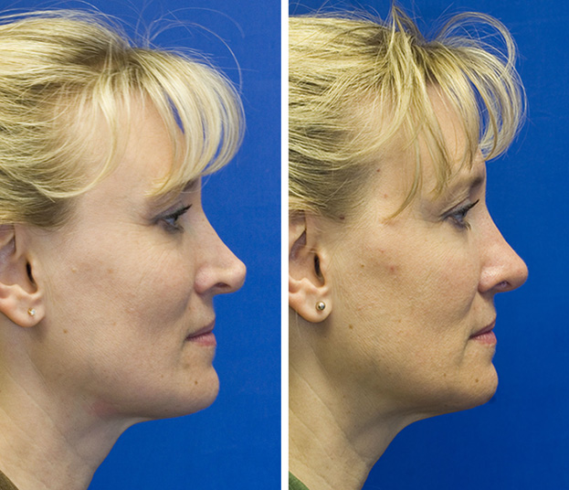 Revision rhinoplasty patient 1 profile