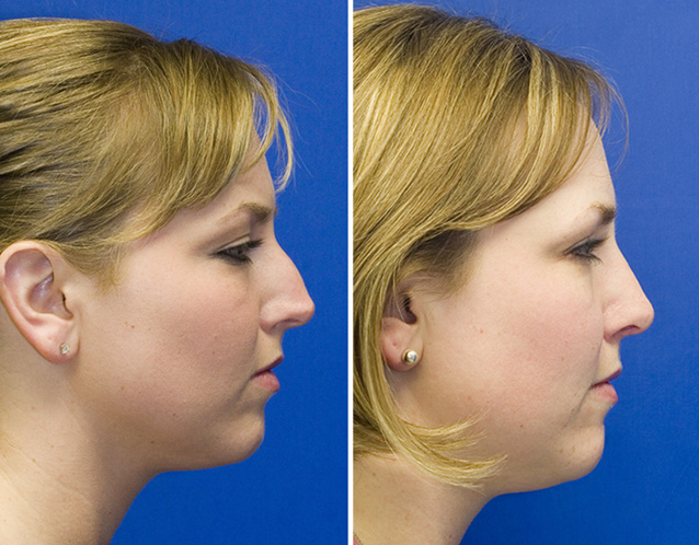 Patient 24 profile hump reduction