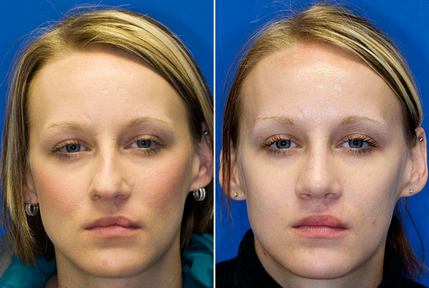 Patient 25 cleft lip deviated nose repair