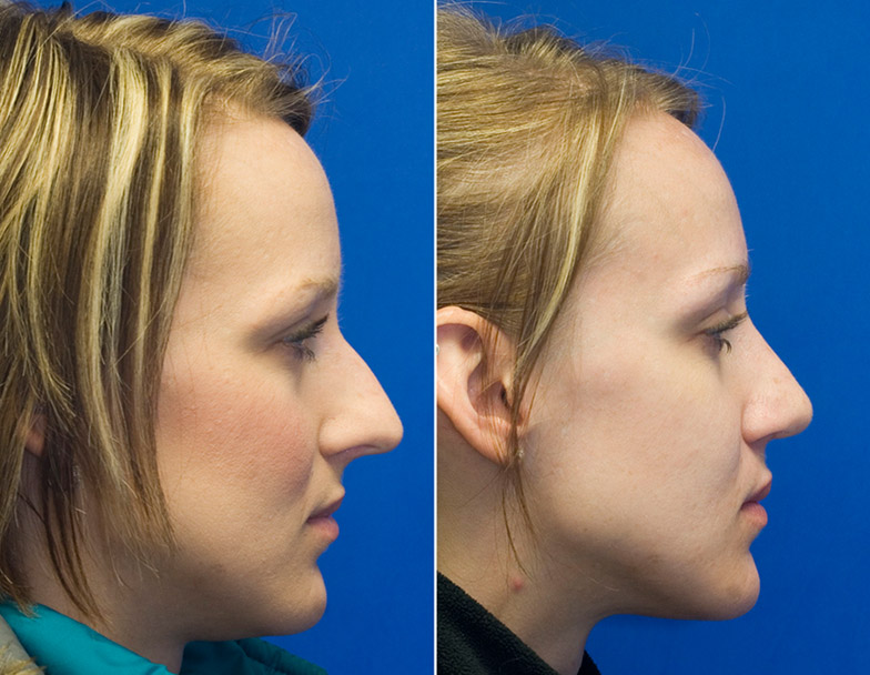 patient 25 profile hump reduction