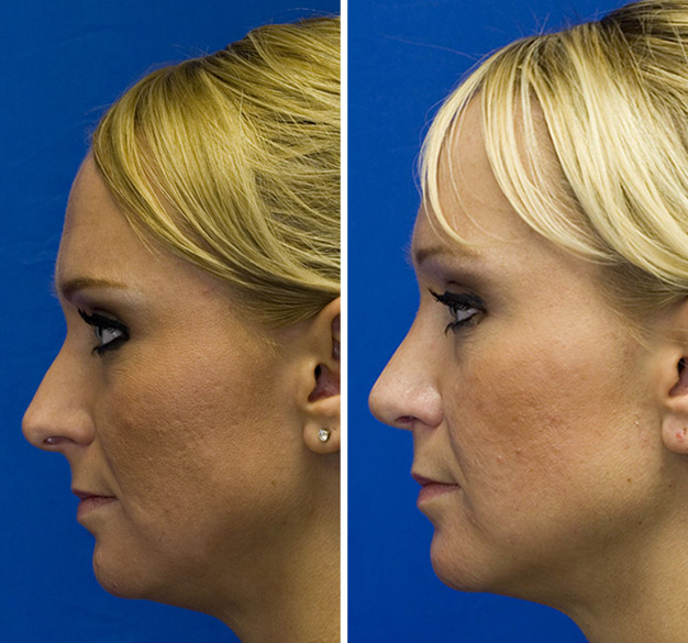 Patient 31 hanging columella repair and hump removal Patient 31 hanging columella repair and hump removal