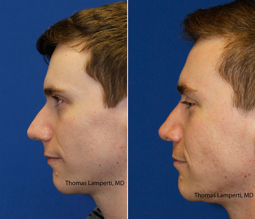 Patient 43 bridge hump removal before and after rhinoplasty.jpg