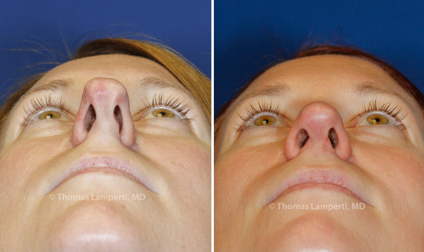 Rhinoplasty patient 44 base boxy tip before and after photos Rhinoplasty patient 44 base boxy tip before and after photos