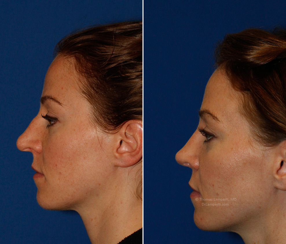 Patient 53 left profile before and after bridge hump removal